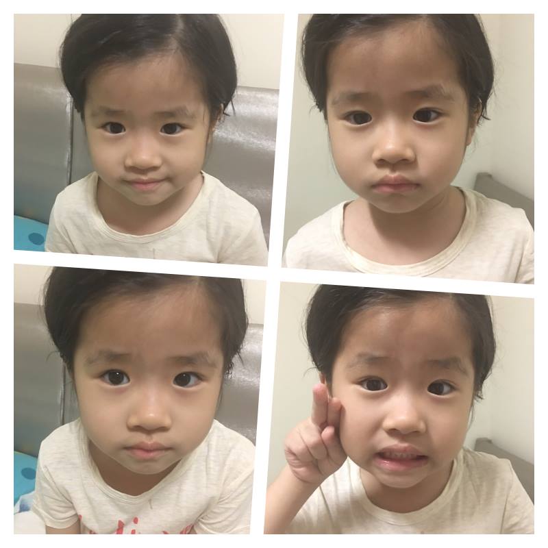 小香瓜的雙眼皮